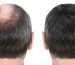 مصرف دوتاستراید برای ریزش مو: میزان کارایی و عوارض آن